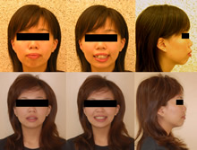 雙顎前突(改變臉型)症案例(五)