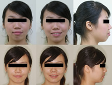 雙顎前突(改變臉型)症案例(六)