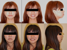 雙顎前突(改變臉型)症案例(七)