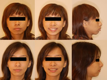 二級一類下顎後縮症案例(二)