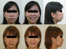 二級一類上顎前突再治療案例(三)