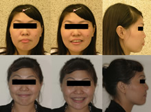 二級一類上顎前突症案例(四)