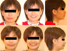 二級一類上顎前突症案例(五)