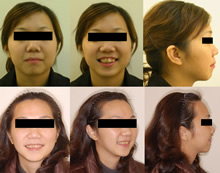 二級一類上顎前突症案例(六)