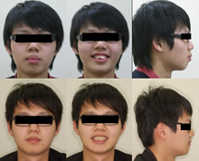二級一類上顎前突症案例(七)