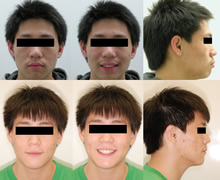 一級雙顎前突症例(二)