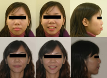 雙顎前突(改變臉型)症案例(一)