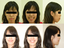 雙顎前突(改變臉型)症案例(二)