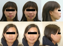 雙顎前突(改變臉型)症案例(三)