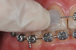 牙齒矯正保護軟蠟使用方法