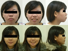 雙顎前突(改變臉型)症案例(八)