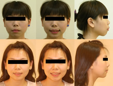 二級二類上顎前突症案例