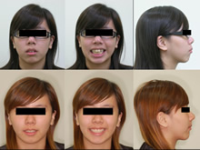 雙顎前突(改變臉型)症案例(四)
